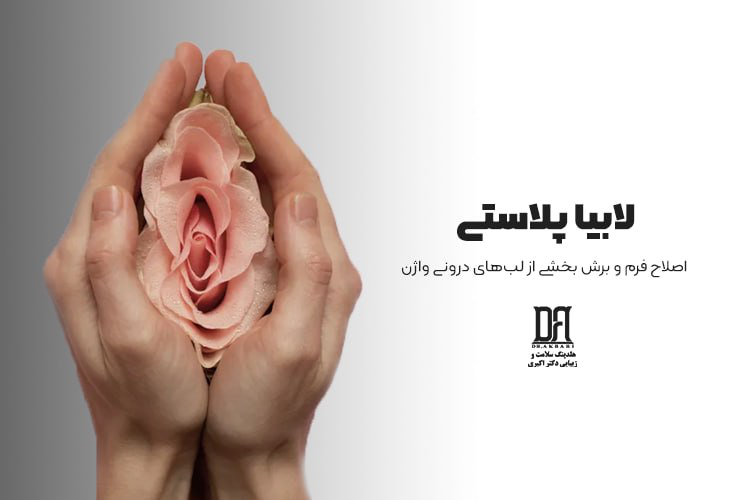 لابیاپلاستی