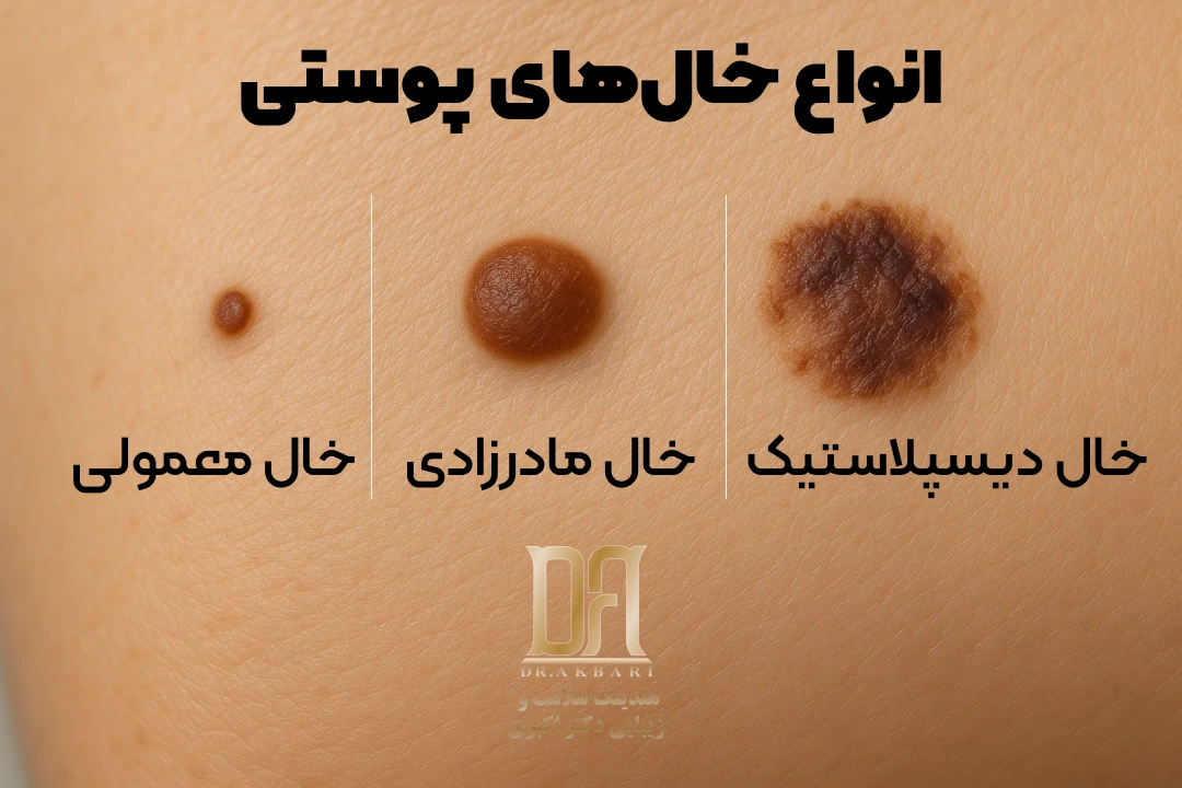 برداشت انواع خالهای پوستی در کلینیک دکتر اکبری فرمانیه تهران