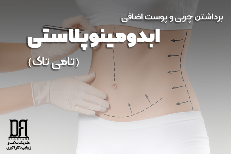 ابدومینوپلاستی