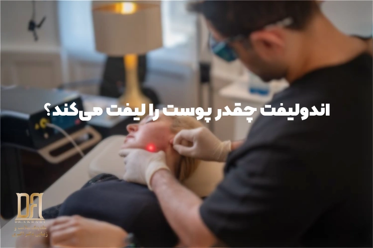 اندولیفت چقدر پوست را لیفت می‌کند؟ بررسی ماندگاری، نتیجه و عوارض
