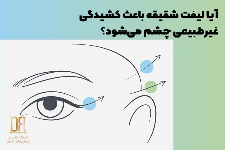 آیا لیفت شقیقه باعث کشیدگی غیرطبیعی چشم می‌شود؟