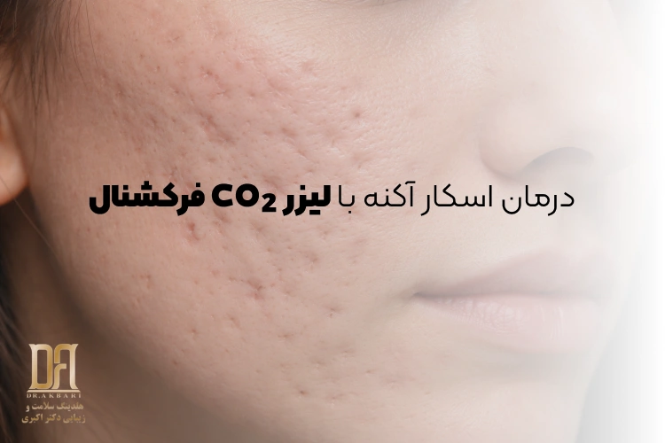 درمان اسکار آکنه با لیزر CO₂ فرکشنال همراه با داروهای کمکی