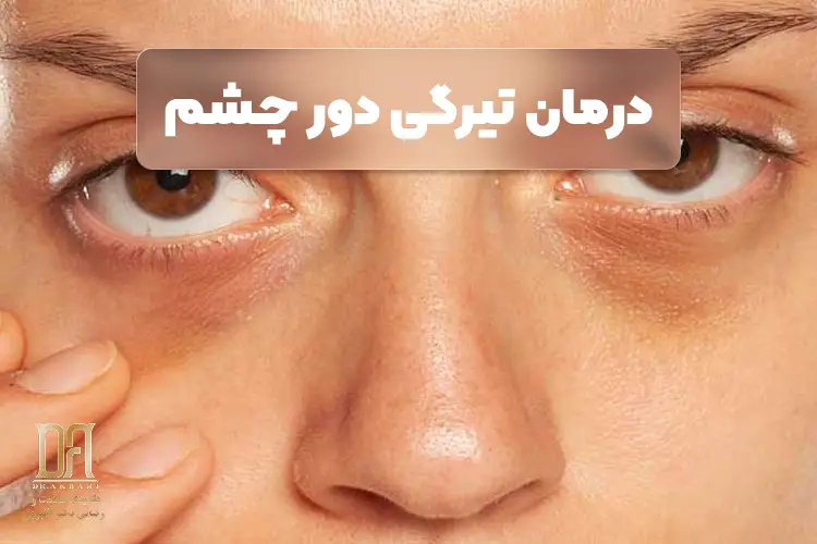 درمان تیرگی دور چشم؛ علت‌ها، کرم‌ها و روش‌های کلینیکی