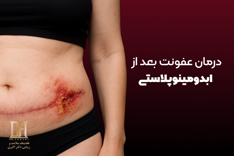 عفونت ناف بعد از ابدومینوپلاستی: علل، علائم، پیشگیری و درمان