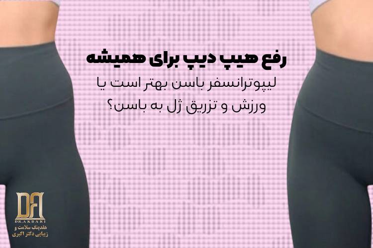 رفع هیپ دیپ برای همیشه | لیپوترانسفر باسن بهتر است یا ورزش و تزریق ژل به باسن؟