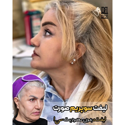 لیفت سوپریم بدون محدودیت سن و بدون برش در کلینیک دکتر اکبری