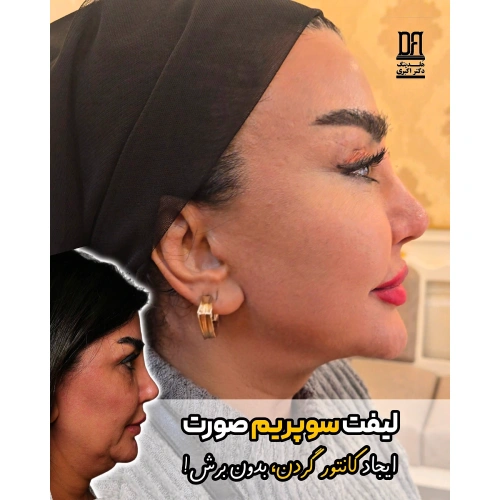 لیفت کامل صورت و گردن با لیفت سوپریم