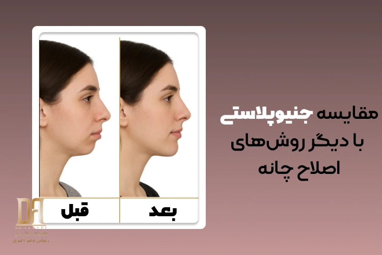 مقایسه جنیوپلاستی با دیگر روش‌های زاویه‌سازی فک و چانه (تزریق، فیلر، لیفت)