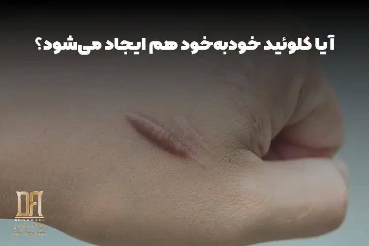 کلوئید بدون زخم: آیا کلوئید خودبه‌خود هم ایجاد می‌شود؟