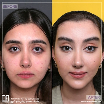 ساکشن گونه، لیفت شقیقه، کانتوپلاستی و جنیوپلاستی