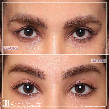 اپی کانتوپلاستی و لیفت شقیقه