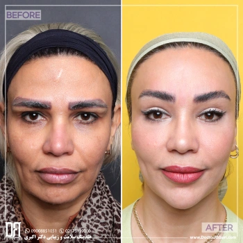 بلفاروپلاستی + جنیوپلاستی ، لیفت شقیقه، گونه و پیشانی