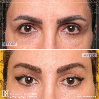 بلفاروپلاستی و لیفت شقیقه