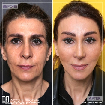 لیفت پیشانی، شقیقه و گونه + تراش استخوان ابرو