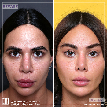 تراش استخوان ابرو، لیفت شقیقه و جراحی ترمیمی بینی