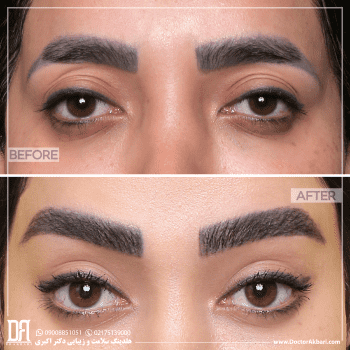 تراش استخوان ابرو لیفت شقیقه توسط دکتر احمدی