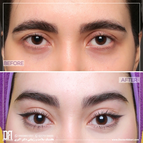 تصویر قبل و بعد لیفت شقیقه