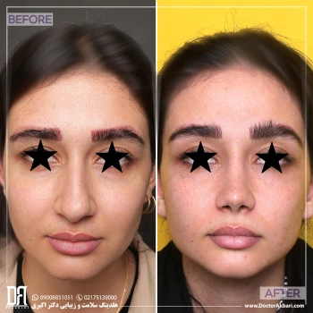 جراحی بینی طبیعی