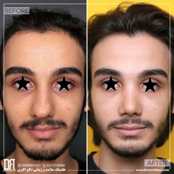 جراحی بینی گوشتی