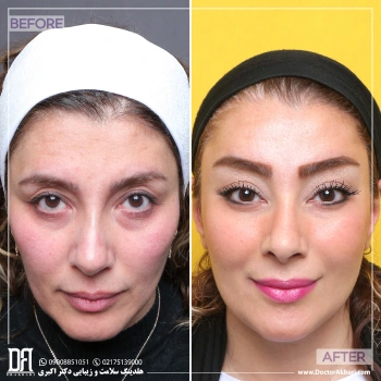 جراحی ترکیبی لیفت شقیقه + پیشانی
