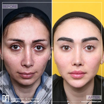 لیفت لب + گونه + شقیقه، جنیوپلاستی و تراش استخوان ابرو