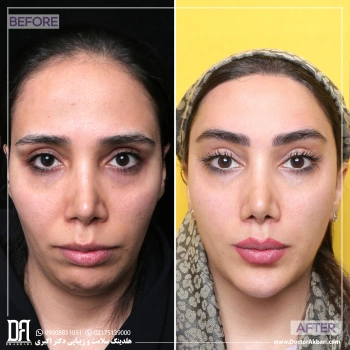 جراحی ترکیبی ناحیه صورت و پیشانی