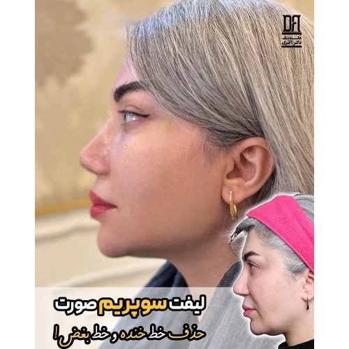 حذف خط خنده و بغض و لیفت کامل صورت با لیفت سوپریم