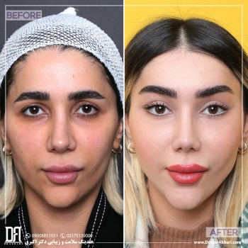 رینوپلاستی ترمیمی، لیفت پیشانی و شقیقه