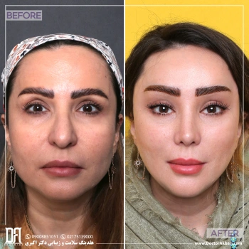 رینوپلاستی، لیفت شقیقه + پیشانی، تراش استخوان ابرو و ساکشن غبغب