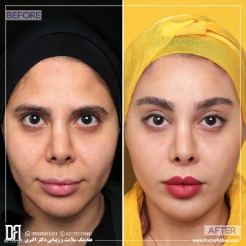 لیفت لب + شقیقه | رینوپلاستی ترمیمی