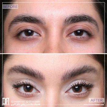 قبل و بعد از لیفت شقیقه در کلینیک دکتر اکبری