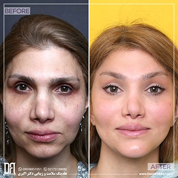 قبل-و-بعد-جنیوپلاستی-کلینیک-دکتر-اکبری