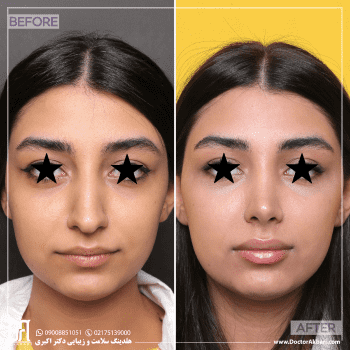 جراحی بینی در کلینیک دکتر اکبری فرمانیه