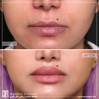 قبل و بعد سانترال لب در کلینیک دکتر اکبری