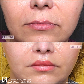 قبل-و-بعد-سانترال-لب-کلینیک-دکتر-اکبری