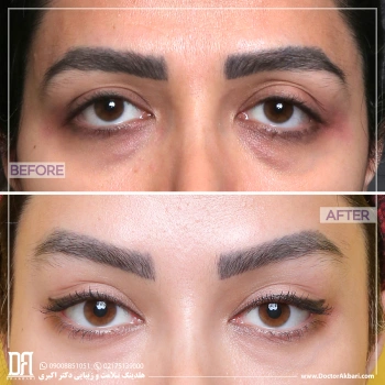 کانتوپلاستی | لیفت شقیقه و پیشانی