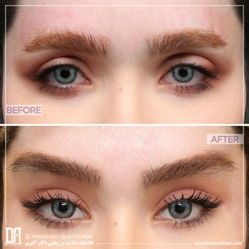 جراحی ترکیبی کانتوپلاستی، تراش استخوان ابرو و لیفت پیشانی + شقیقه