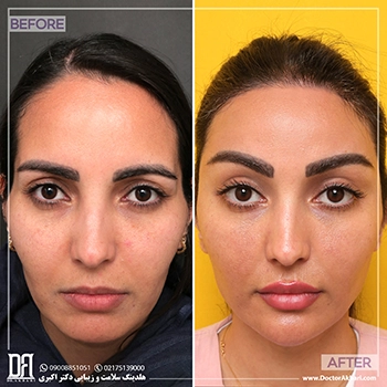 قبل-و-بعد-کوتاهی-پیشانی-و-تراش-استخوان-ناندرتال-و-ابرو