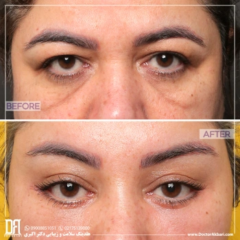 قطع عضله‌ی اخم و لیفت شقیقه