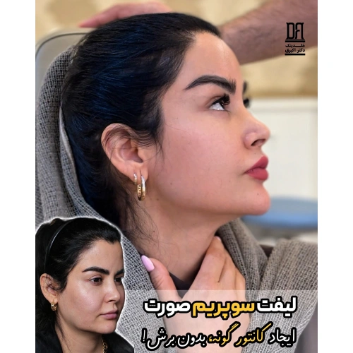 لیفت سوپریم صورت | ایجاد کانتور گونه بدون برش