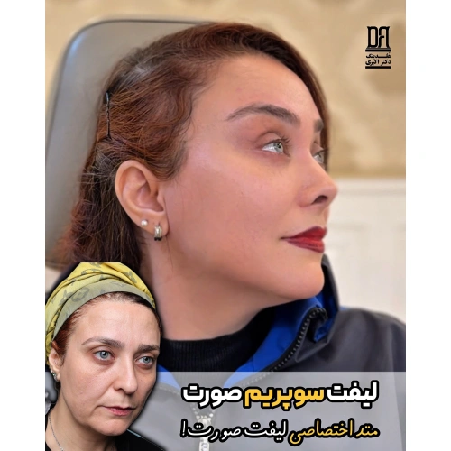 لیفت سوپریم صورت | متد اختصاصی لیفت صورت در هلدینگ دکتر اکبری