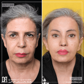 بلفاروپلاستی پلک پایین + لیفت شقیقه، گونه و لب