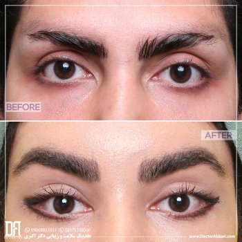 لیفت شقیقه + تراش استخوان ابرو