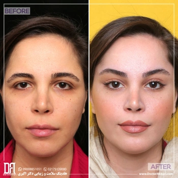 لیفت شقیقه + تراش استخوان ابرو