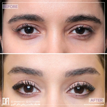 نمونه کار لیفت شقیقه