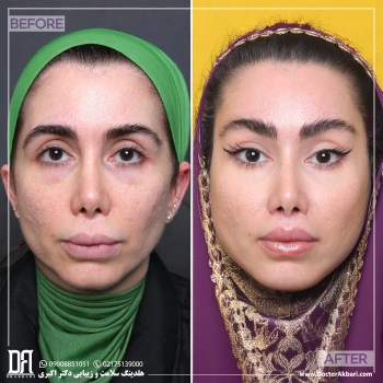 لیفت شقیقه و سانترال لب ترمیمی