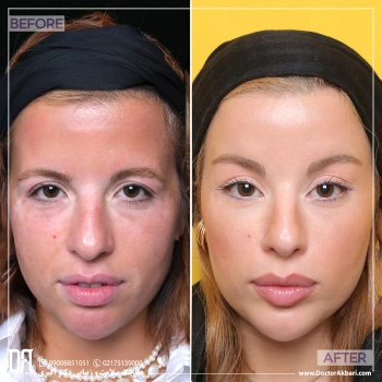 لیفت شقیقه و تراش استخوان ابرو توسط دکتر احمدی