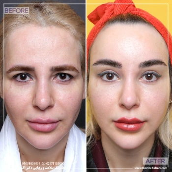 لیفت شقیقه + پیشانی