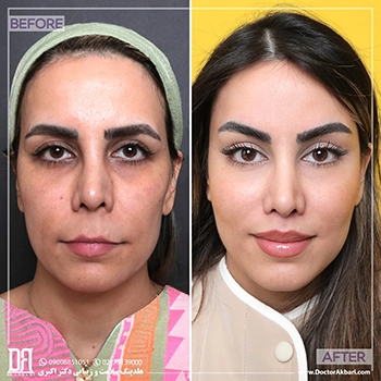 لیفت-شقیقه-و-پیشانی-و-لب