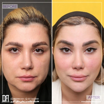 لیفت شقیقه و گونه + تخلیه ژل پاژ